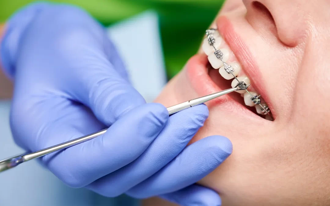 Ceramic vs. Metal Braces: What Are The Differences?